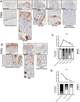 Shared features of metaplasia and the development of adenocarcinoma in the stomach and esophagus